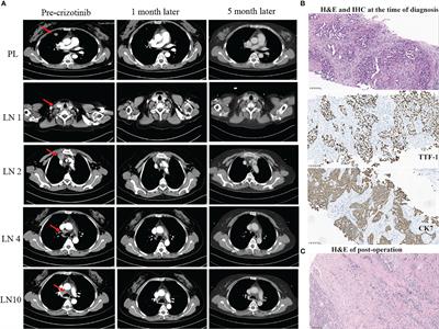 Case report: Complete pathological admission in N3 unresectable locally advanced lung adenocarcinoma with a novel INTS10-ALK and EML4-ALK fusion after neoadjuvant crizotinib